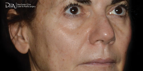 Patient2-B-Side-mid-face