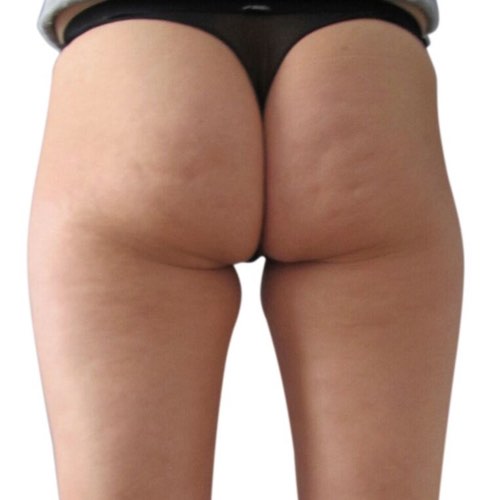 cellulite_4_before