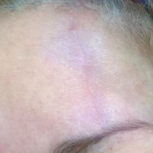 skin_resurfacing_1_after