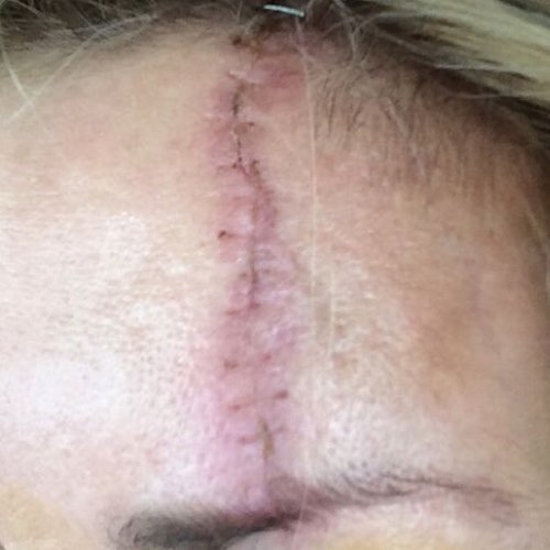 skin_resurfacing_1_before