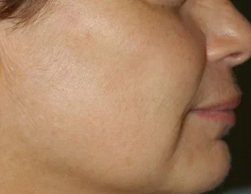 gentlelase after13 gentlelase after13