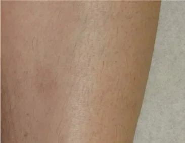 gentlelase after2 gentlelase after2