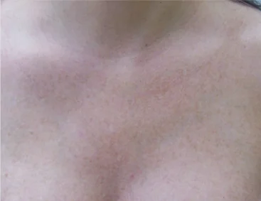 gentlelase after7 gentlelase after7