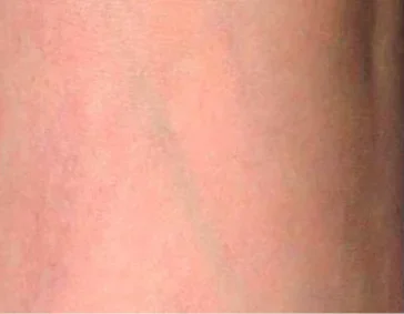 gentlelase after9 gentlelase after9