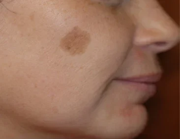 gentlelase before13 gentlelase before13