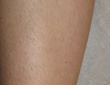 gentlelase before2 gentlelase before2