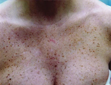 gentlelase before7 gentlelase before7