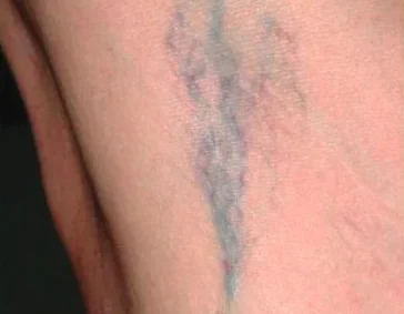 gentlelase before9 gentlelase before9