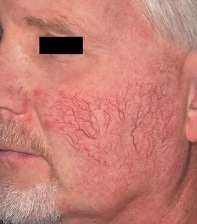 perfecta_before3 perfecta_before3